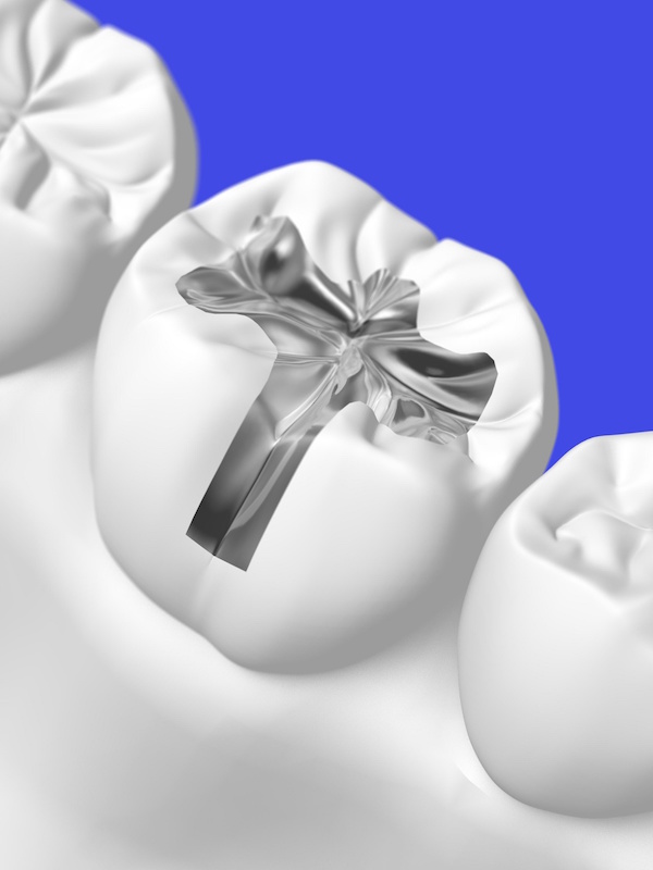 Replace silver fillings with porcelain Smiles By Shields Dentistry