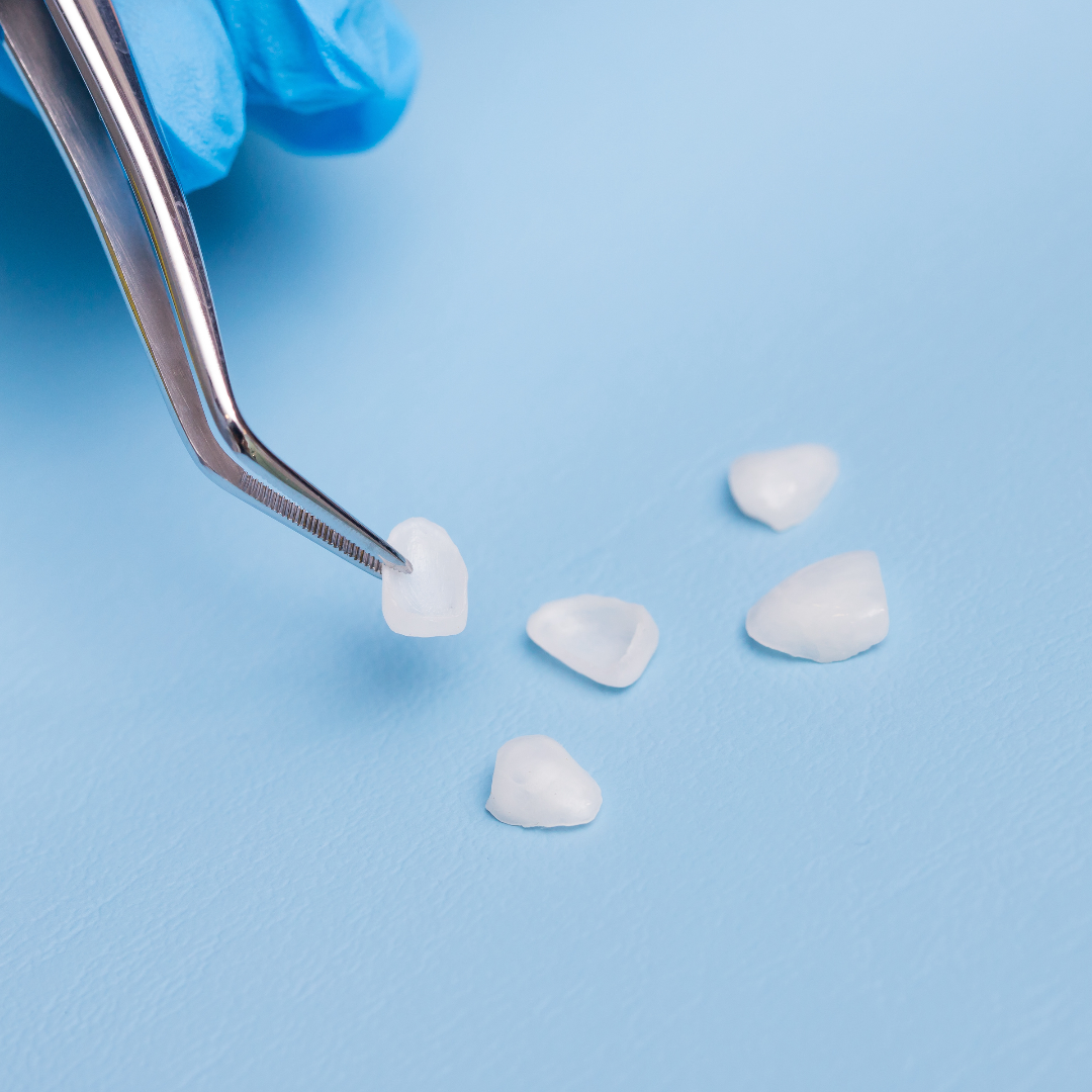 How Long Do Veneers Last On Your Teeth? Smiles by Shields